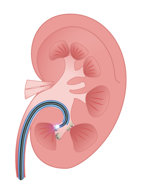 MacroLux Ureteroscopes 