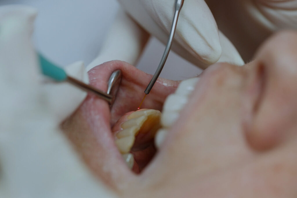 Dental laser used on a patient on soft and hard tissue.