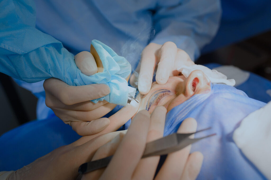 Doctor performing an eyelid surgery with laser.