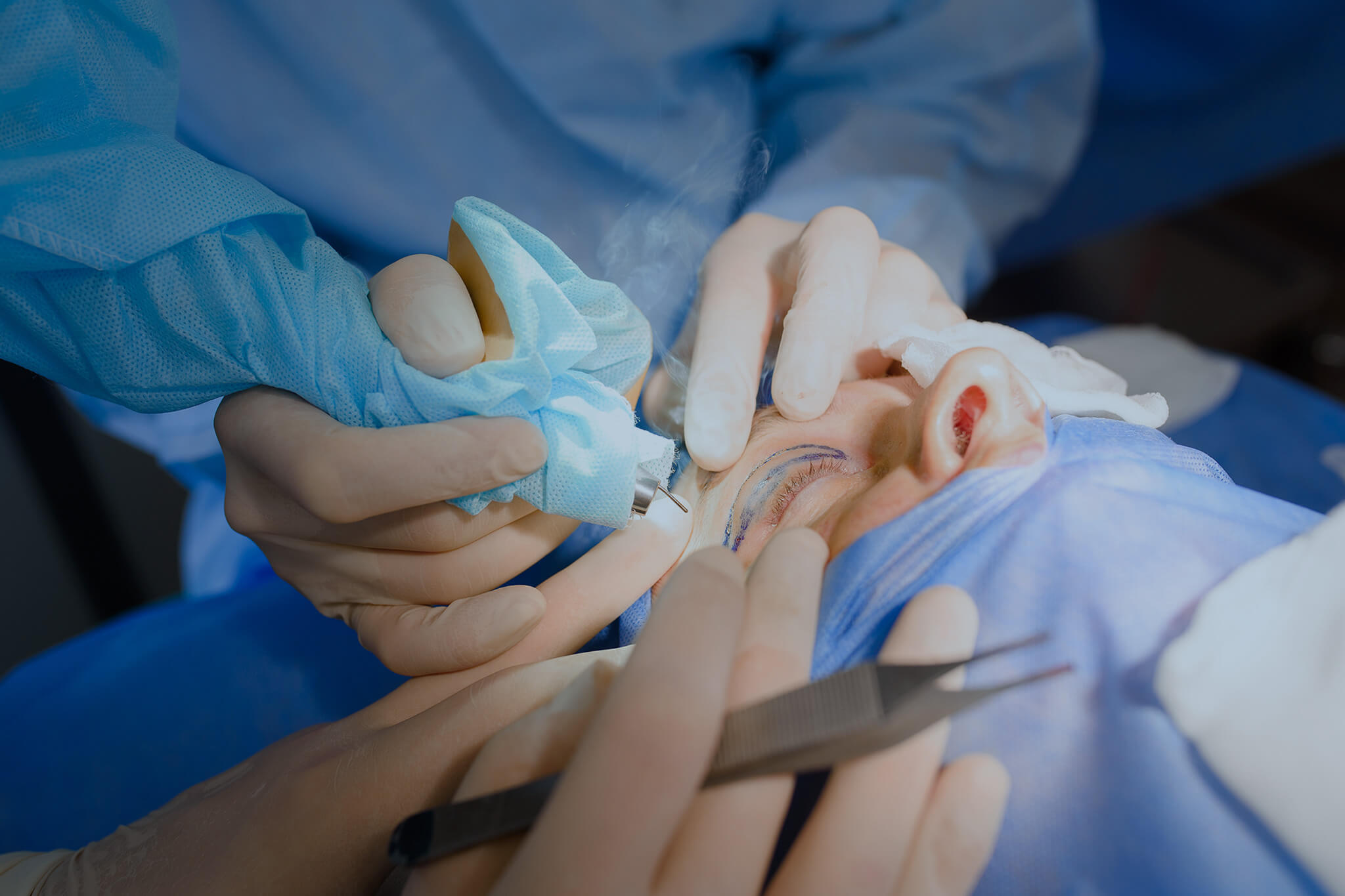 Doctor performing an eyelid surgery with laser.
