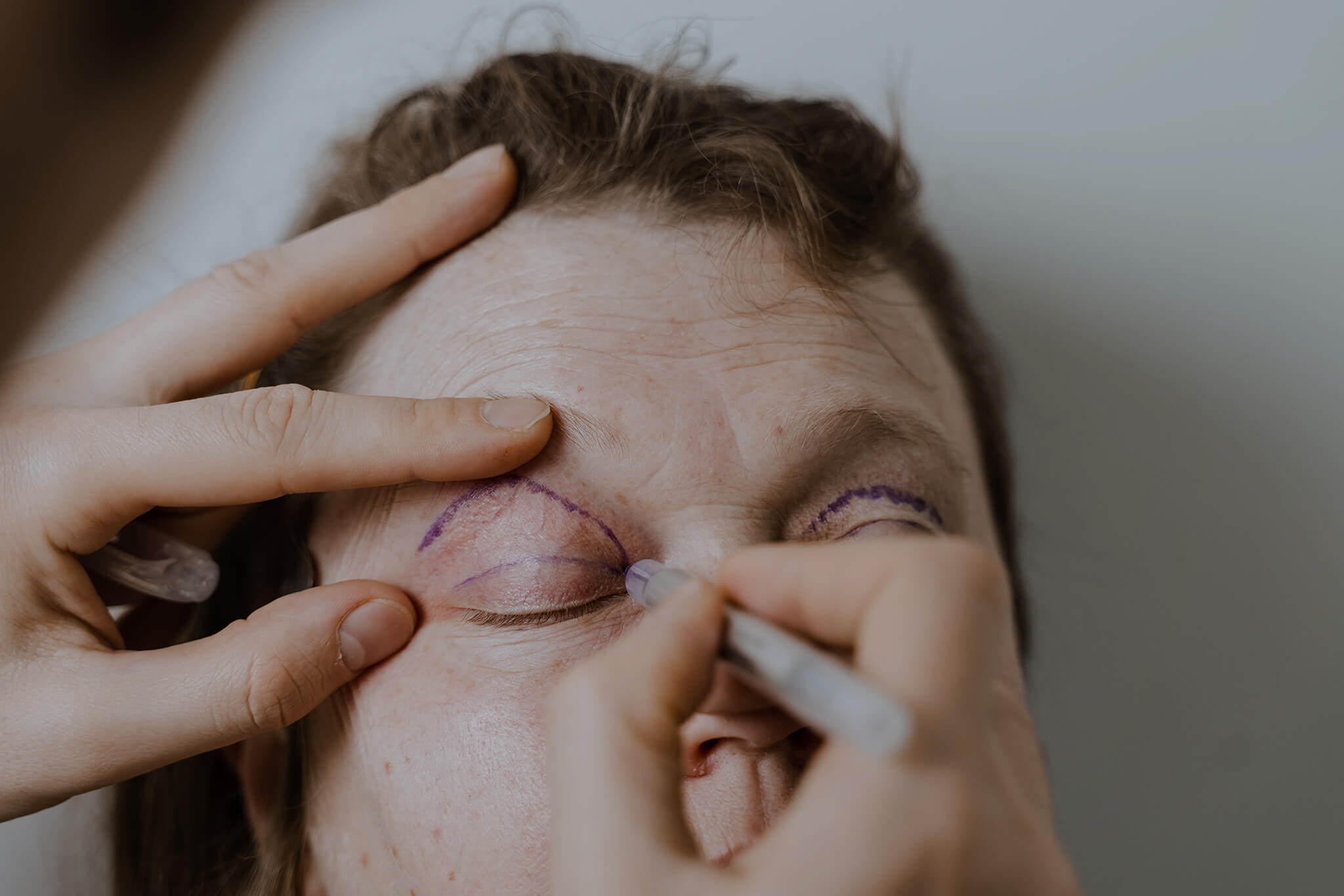 Blepharoplasty markup on patient face.