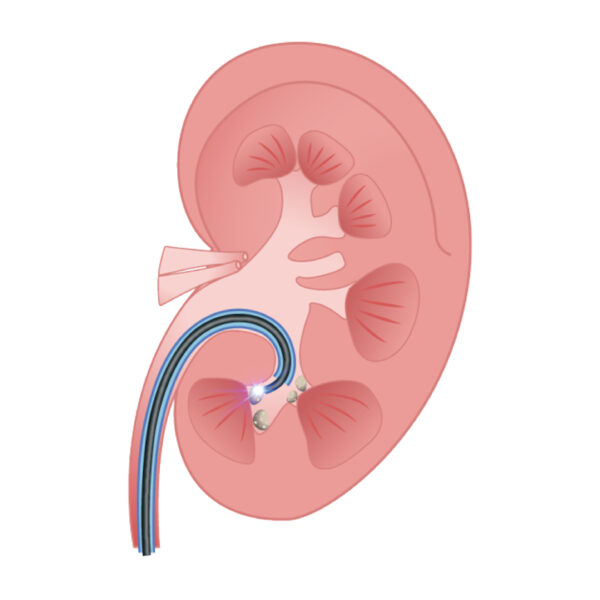 MacroLux CorelView Single-Use Ureteroscope - Image 3