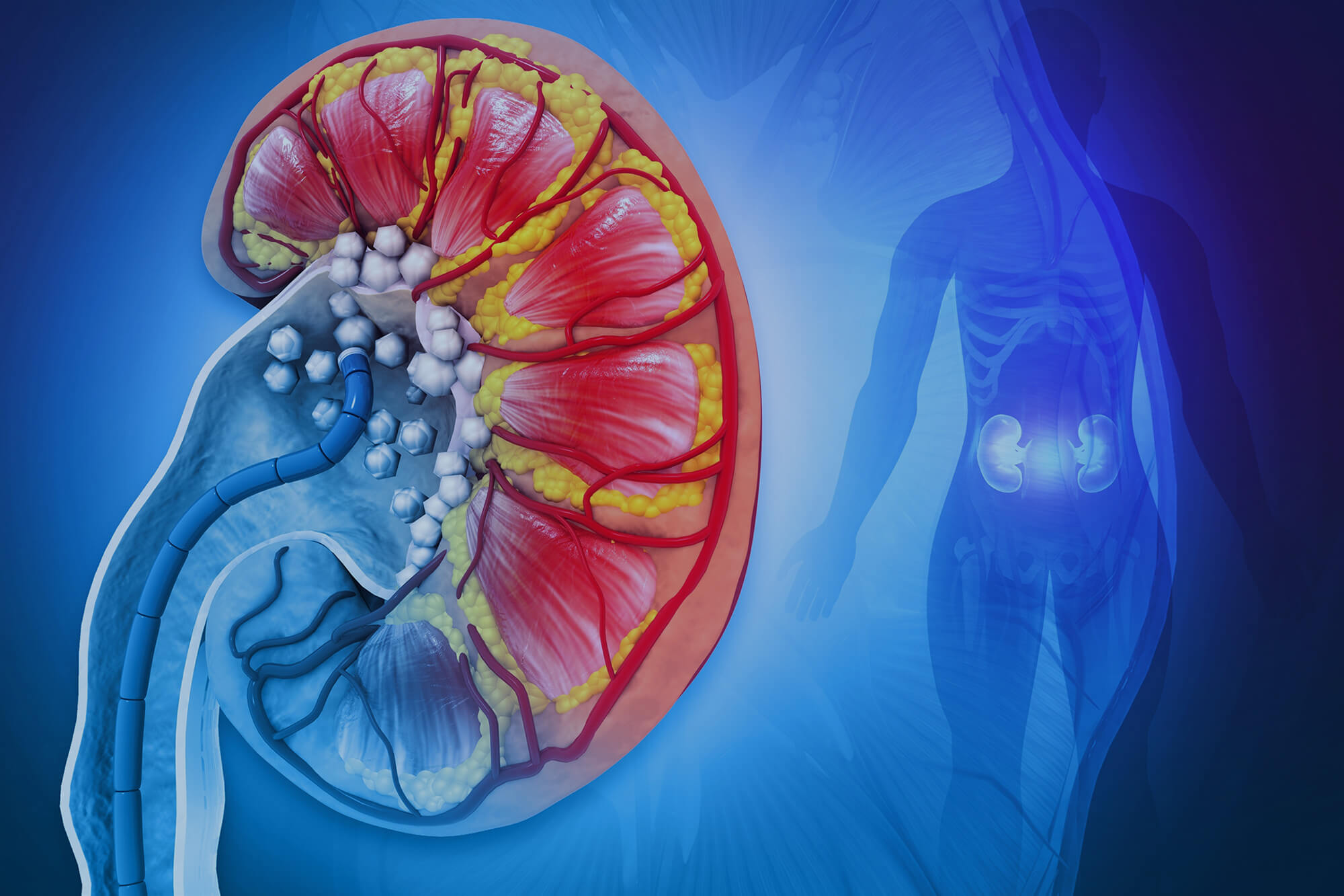 Remove kidney stones. 3d illustration.
